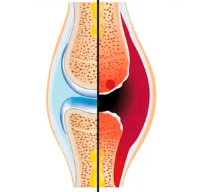 Der Aufbau eines gesunden und abgenutzten Gelenks mit der Bezeichnung Knorpelgewebe und Gelenkflüssigkeit