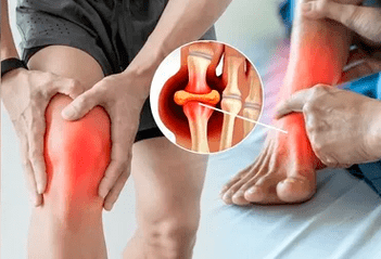 Schema zum Auftragen von Icexin-Gel auf den Bereich des Kniegelenks und des Fußes