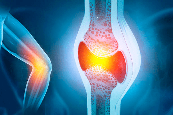 Vorbeugung von Gelenkerkrankungen